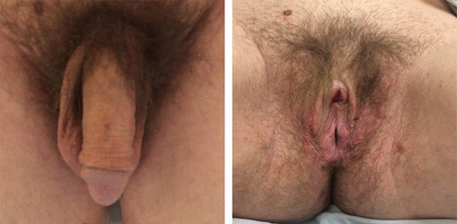 vaginoplasty-008.jpg vaginoplasty-008.jpg