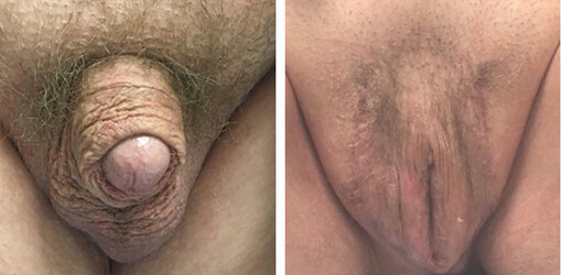 vaginoplasty-007.jpg vaginoplasty-007.jpg