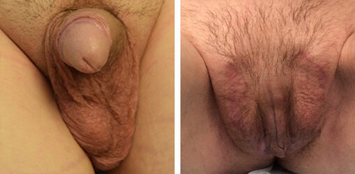 vaginoplasty-006.jpg vaginoplasty-006.jpg