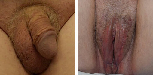 vaginoplasty-001.jpg vaginoplasty-001.jpg