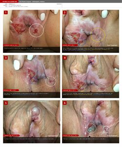 Hyper-granularization-treatment.jpg Hyper-granularization-treatment.jpg