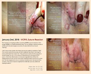 suture-reaction.jpg suture-reaction.jpg