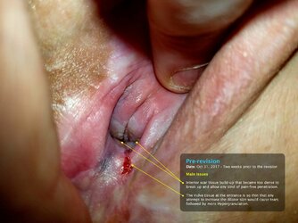 Pre-Revision-Vulva.jpg Pre-Revision-Vulva.jpg