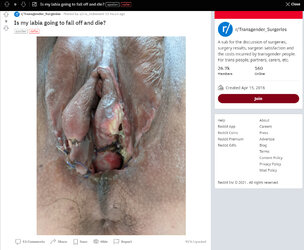 Is_my_labia_going_to_fall_off.jpg Is_my_labia_going_to_fall_off.jpg