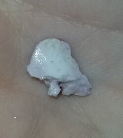 Tonsil_stones1.jpg Tonsil_stones1.jpg