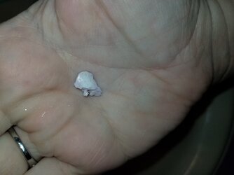 Tonsil_stones2.jpg Tonsil_stones2.jpg