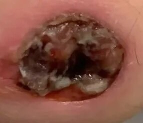 meatus1.jpg meatus1.jpg