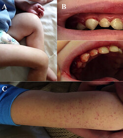 skin and oral scurvy.jpg skin and oral scurvy.jpg
