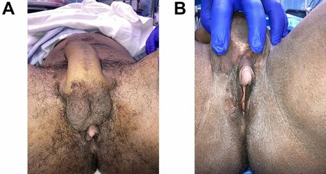 A-and-B-Patient-is-shown-4-months-following-insertion-of-silicone-testicular-implants.jpg A-and-B-Patient-is-shown-4-months-following-insertion-of-silicone-testicular-implants.jpg