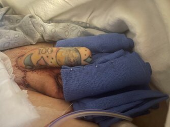 one-day-post-op-rff-phalloplasty-v0-affobjy7e6t91.jpg one-day-post-op-rff-phalloplasty-v0-affobjy7e6t91.jpg
