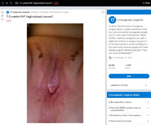 Labia_blockage1.jpg Labia_blockage1.jpg