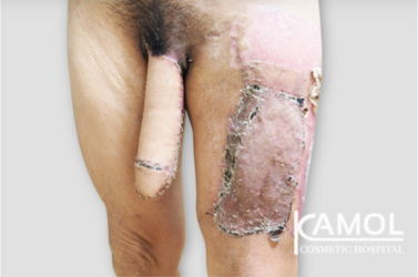 ALT-Phalloplasty-RFF-Phalloplasty-FFF-Phalloplasty-Kamol-Cosmetic-Hospital(3).png ALT-Phalloplasty-RFF-Phalloplasty-FFF-Phalloplasty-Kamol-Cosmetic-Hospital(3).png