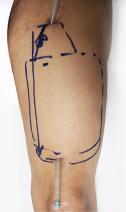 ALT-Phalloplasty-RFF-Phalloplasty-FFF-Phalloplasty-Kamol-Cosmetic-Hospital(2).png ALT-Phalloplasty-RFF-Phalloplasty-FFF-Phalloplasty-Kamol-Cosmetic-Hospital(2).png