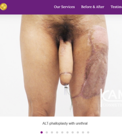 ALT-Phalloplasty-RFF-Phalloplasty-FFF-Phalloplasty-Kamol-Cosmetic-Hospital(1).png ALT-Phalloplasty-RFF-Phalloplasty-FFF-Phalloplasty-Kamol-Cosmetic-Hospital(1).png