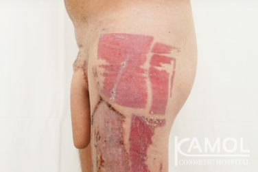ALT-Phalloplasty-RFF-Phalloplasty-FFF-Phalloplasty-Kamol-Cosmetic-Hospital32.png ALT-Phalloplasty-RFF-Phalloplasty-FFF-Phalloplasty-Kamol-Cosmetic-Hospital32.png