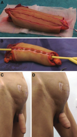 one-stage-phalloplasty-and-urethroplasty-using-only-the-lDF-resources-a-intraoperative.png one-stage-phalloplasty-and-urethroplasty-using-only-the-lDF-resources-a-intraoperative.png