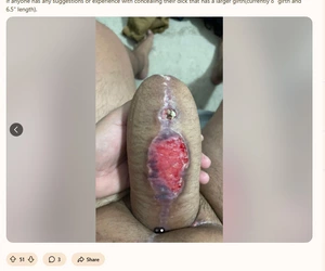 Keloid_phallo2.jpg Keloid_phallo2.jpg
