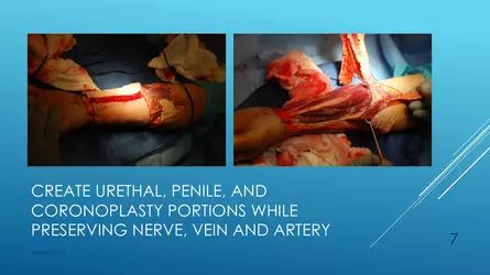 Santucci-Complications_of_Phalloplasty_Fried_Symposium_2019_007.jpg Santucci-Complications_of_Phalloplasty_Fried_Symposium_2019_007.jpg