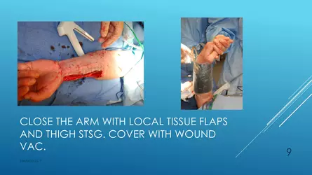 Santucci-Complications_of_Phalloplasty_Fried_Symposium_2019_009.jpg Santucci-Complications_of_Phalloplasty_Fried_Symposium_2019_009.jpg