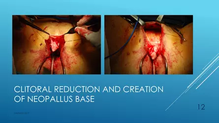 Santucci-Complications_of_Phalloplasty_Fried_Symposium_2019_012.jpg Santucci-Complications_of_Phalloplasty_Fried_Symposium_2019_012.jpg