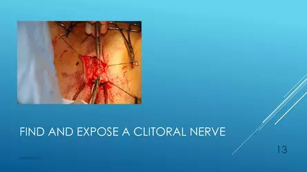 Santucci-Complications_of_Phalloplasty_Fried_Symposium_2019_013.jpg Santucci-Complications_of_Phalloplasty_Fried_Symposium_2019_013.jpg