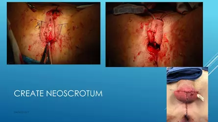 Santucci-Complications_of_Phalloplasty_Fried_Symposium_2019_014.jpg Santucci-Complications_of_Phalloplasty_Fried_Symposium_2019_014.jpg