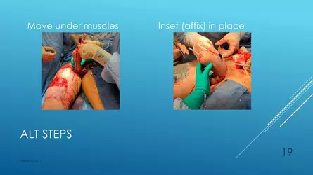 Santucci-Complications_of_Phalloplasty_Fried_Symposium_2019_019.jpg Santucci-Complications_of_Phalloplasty_Fried_Symposium_2019_019.jpg