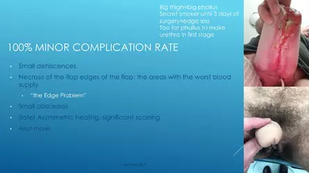 Santucci-Complications_of_Phalloplasty_Fried_Symposium_2019_025.jpg Santucci-Complications_of_Phalloplasty_Fried_Symposium_2019_025.jpg