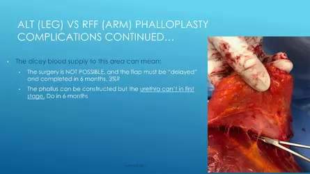 Santucci-Complications_of_Phalloplasty_Fried_Symposium_2019_028.jpg Santucci-Complications_of_Phalloplasty_Fried_Symposium_2019_028.jpg