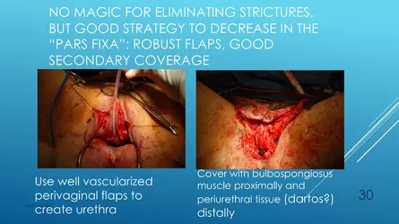 Santucci-Complications_of_Phalloplasty_Fried_Symposium_2019_030.jpg Santucci-Complications_of_Phalloplasty_Fried_Symposium_2019_030.jpg