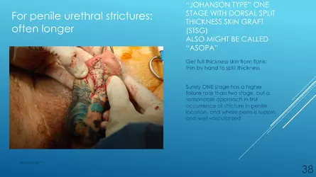 Santucci-Complications_of_Phalloplasty_Fried_Symposium_2019_038.jpg Santucci-Complications_of_Phalloplasty_Fried_Symposium_2019_038.jpg
