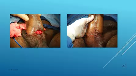 Santucci-Complications_of_Phalloplasty_Fried_Symposium_2019_041.jpg Santucci-Complications_of_Phalloplasty_Fried_Symposium_2019_041.jpg