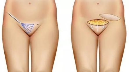 Monsplasty-–-Surgery-for-Bulging-Mons.webp Monsplasty-–-Surgery-for-Bulging-Mons.webp