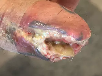 abdominal-phalloplasty-stage-1-uk-update-1-month-post-op-v0-i1arnnbgwjye1.webp abdominal-phalloplasty-stage-1-uk-update-1-month-post-op-v0-i1arnnbgwjye1.webp