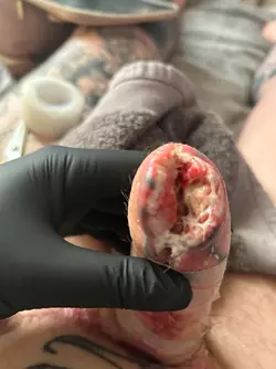 abdominal-phalloplasty-stage-1-uk-update-1-month-post-op-v0-cqfqnsbgwjye1.webp abdominal-phalloplasty-stage-1-uk-update-1-month-post-op-v0-cqfqnsbgwjye1.webp
