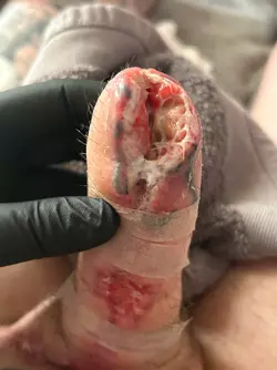 abdominal-phalloplasty-stage-1-uk-update-1-month-post-op-v0-l48irnbgwjye1.webp abdominal-phalloplasty-stage-1-uk-update-1-month-post-op-v0-l48irnbgwjye1.webp