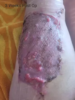 3-weeks-post-op-stage-1-alt-phallo-with-dr-mijuscovic-in-v0-d7t9fekf945f1.webp 3-weeks-post-op-stage-1-alt-phallo-with-dr-mijuscovic-in-v0-d7t9fekf945f1.webp