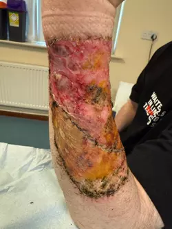 update-rff-arm-graft-4weeks-post-op-v0-2apw582mangf1.webp update-rff-arm-graft-4weeks-post-op-v0-2apw582mangf1.webp