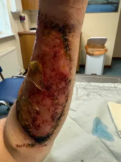 update-rff-arm-graft-4weeks-post-op-v0-c9badi2mangf1.webp update-rff-arm-graft-4weeks-post-op-v0-c9badi2mangf1.webp