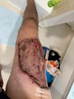 16-days-post-op-stage-1-alt-v0-pqhhk5ksttgf1.webp 16-days-post-op-stage-1-alt-v0-pqhhk5ksttgf1.webp