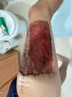 16-days-post-op-stage-1-alt-v0-85hz9xksttgf1.webp 16-days-post-op-stage-1-alt-v0-85hz9xksttgf1.webp