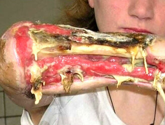 krokodile-drug-flesh-eating-2.jpg