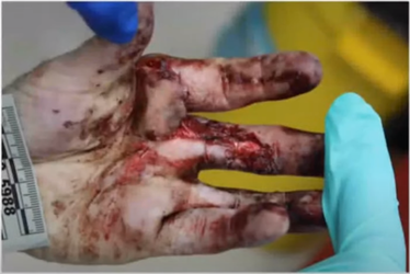 094 Rosenbaum left hand.png