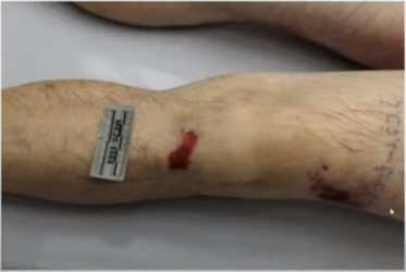 101 Rosenbaum leg.png