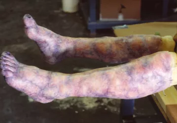 gout.jpg