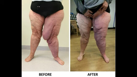 Lymphoedema Debulking Surgery - Before & After.jpeg