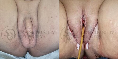 constructive-surgery-vaginoplasty-miami-front-before-after-aHF5OMAhT6.jpeg
