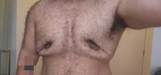 horror-top-surgery-results-v0-e1es3b5v4h0f1.webp