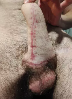2-mo-post-debulking-implants-delayed-alt-v0-n7r825nvs2gf1.webp