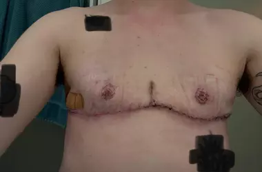pre-op-7weeks-post-op-breast-reduction-top-surgery-v0-t93b5ikzh7hf1.webp